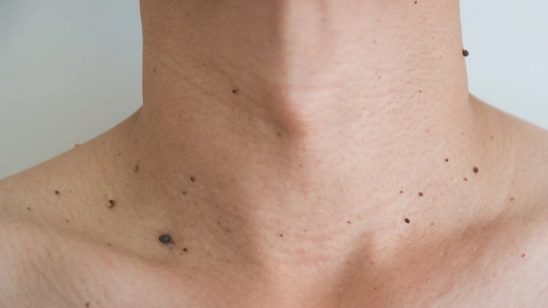Photo of neck with skin tags that may need removed