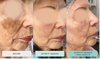 Facial treatment after 3 sessions